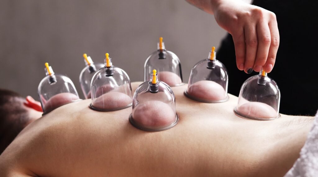 CUPPING THERAPY